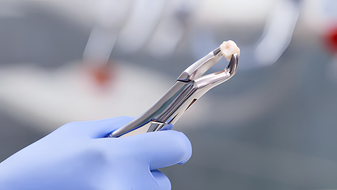 A dentist holding a tooth from a perfect extraction