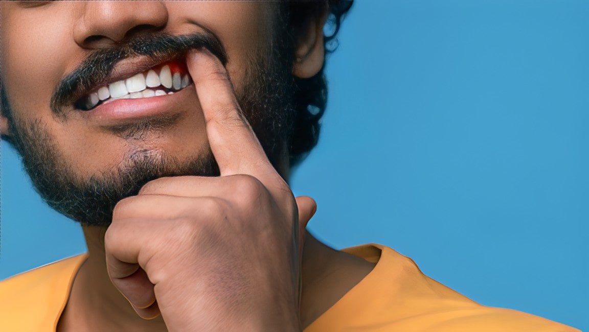 A young indian man pushing up the corner of his mouth to display his healthy gums.
